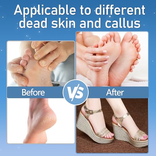Callus Remover for Feet, Electric Foot Callus Remover Waterproof with 3 Rollers 2 Speed Battery Display,17 in1 Rechargeable Foot File Pedicure Kits for Dead Hard Cracked Dry Skin（White - style: White