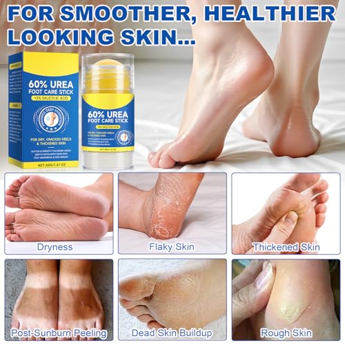 60% Urea Cream Stick plus 2% Salicylic Acid, Maximum Strength Urea Foot Cream Callus Remover for Dry Cracked Heels, Hands, Knees,Exfoliating Moisturizer, Dead Skin Remover Foot Balm 1.4oz (1pcs) - size: 1.41 Fl Oz (Pack of 1)