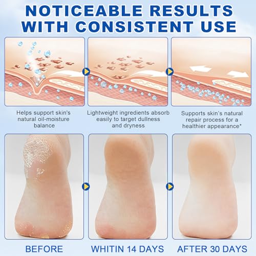 60% Urea Cream Stick plus 2% Salicylic Acid, Maximum Strength Urea Foot Cream Callus Remover for Dry Cracked Heels, Hands, Knees,Exfoliating Moisturizer, Dead Skin Remover Foot Balm 1.4oz (1pcs) - size: 1.41 Fl Oz (Pack of 1)